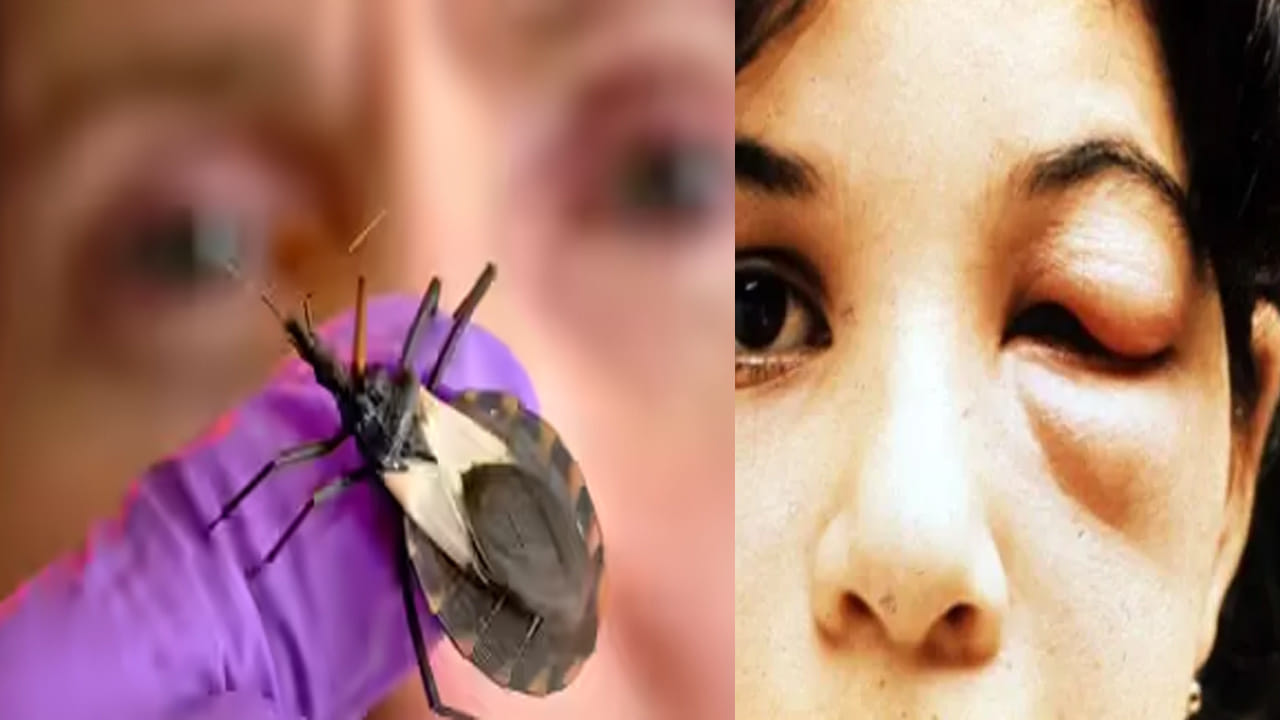 Kissing Bug: అగ్రరాజ్యాన్ని వణికిస్తున్న చిన్న కీటకం.. ప్రాణాంతకమైన చాగస్ వ్యాధి వ్యాప్తి.. లక్షణాలు ఏమిటంటే