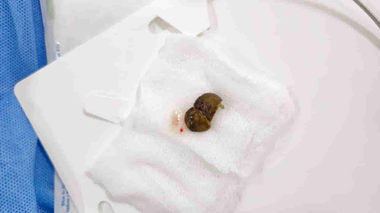 Hyderabad: దగ్గు వస్తుందని కరక్కాయ బుగ్గన పెట్టుకుని పడుకున్న మహిళ.. కట్ చేస్తే..