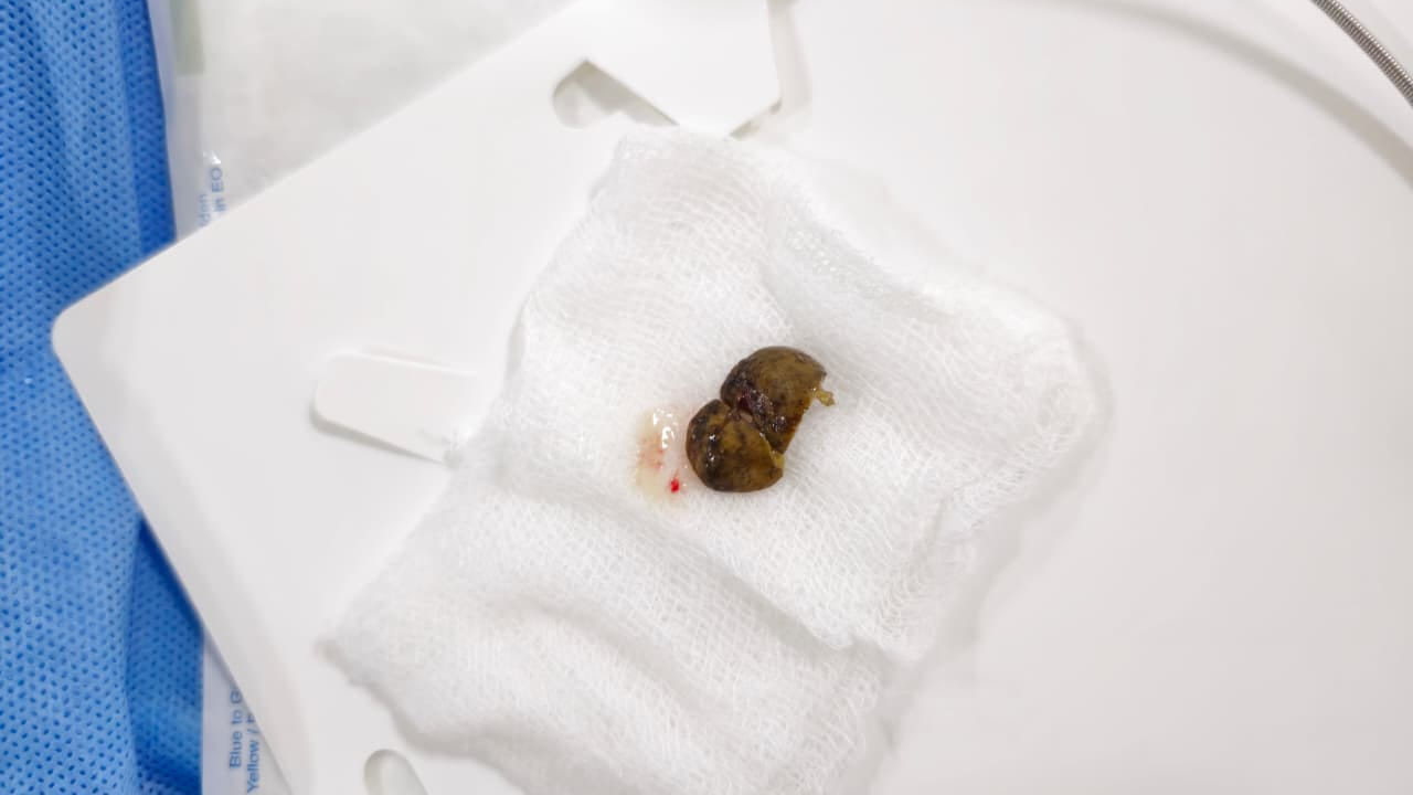 Hyderabad: దగ్గు వస్తుందని కరక్కాయ బుగ్గన పెట్టుకుని పడుకున్న మహిళ.. కట్ చేస్తే..