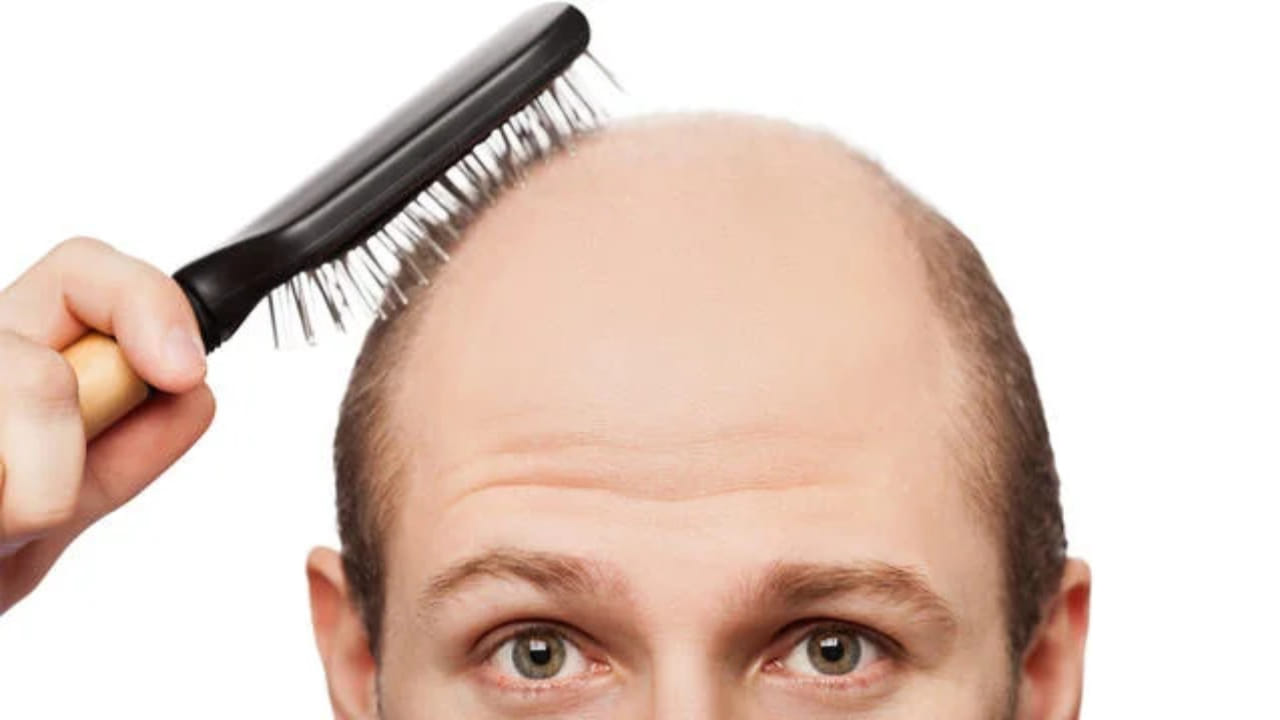 Baldness Cure: దేవుడా! ఇక బట్టతల మాయం... జుట్టు తిరిగి పెంచే మందు కనిపెట్టారు!