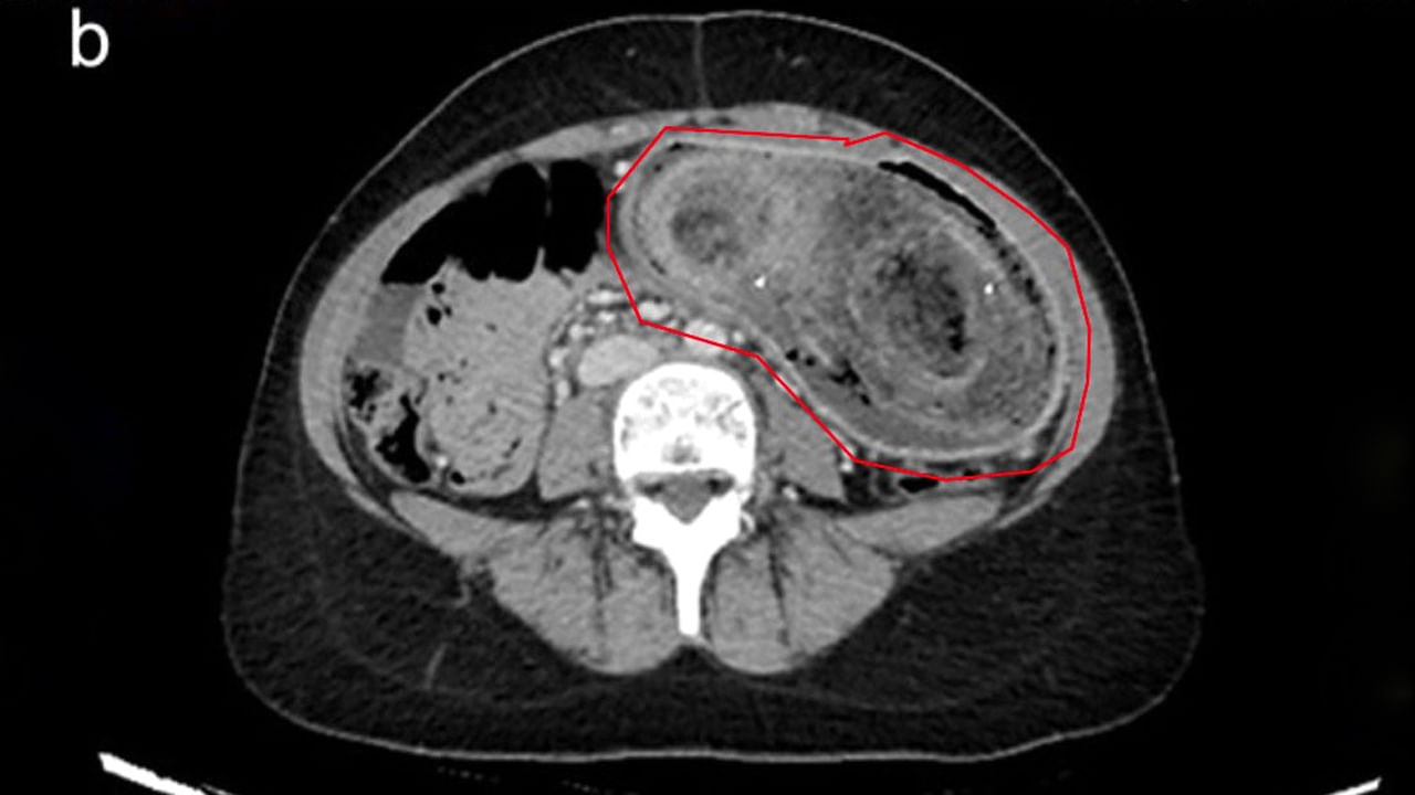 Viral: ఏం తిన్నా వాంతులే, కడుపులో చిత్రవిచిత్ర శబ్దాలు.. CT స్కాన్ చూసి కళ్లు తేలేసిన డాక్టర్లు