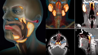 Panipuri: అబ్బ.. పానీపూరీ తింటున్నారా..? 30 రోజులు ఆస్పత్రి పాలైన ఇంజనీర్.. ఈ కథ తెలిస్తే కళ్లు బైర్లే