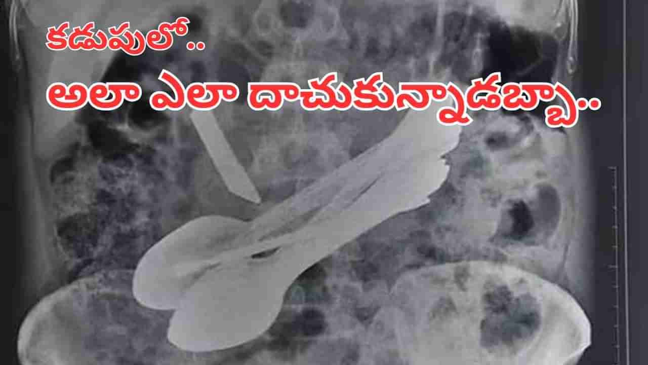 Viral Video: కడుపు నొప్పితో ఆసుపత్రికి.. స్కాన్ చేసి బిత్తరపోయిన డాక్టర్లు..