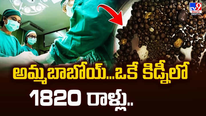 అమ్మబాబోయ్.. ఒకే కిడ్నీలో 1820 రాళ్లు.. అమ్మబాబోయ్.. ఒకే కిడ్నీలో 1820 రాళ్లు..