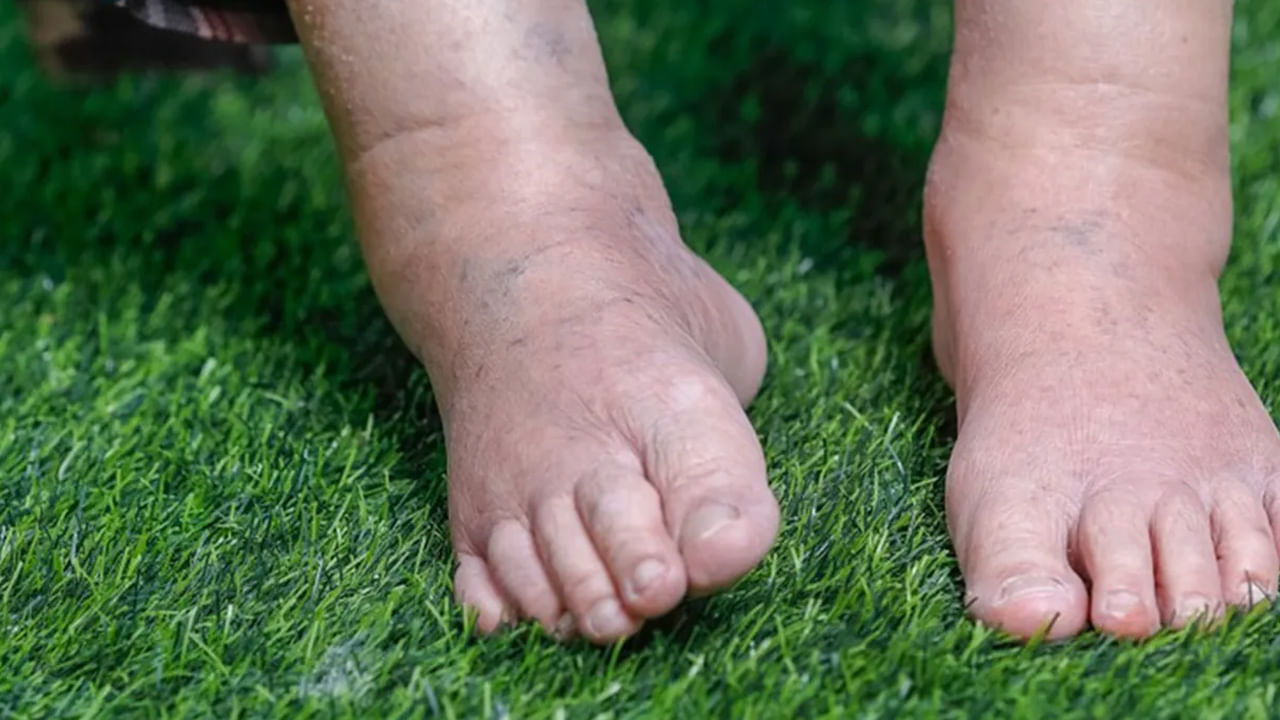 Swollen Feet Photo