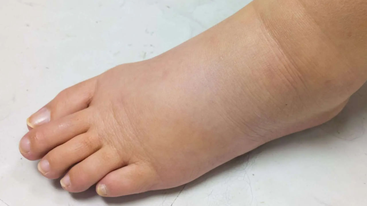Swollen Feet Pic