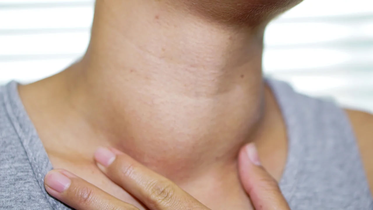 శరీరంలో థైరాయిడ్ హార్మోన్ల సమతుల్యతను కాపాడుకోవడానికి, రోగనిరోధక శక్తిని పెంచడానికి మందులు అవసరం. అయితే కేవలం మందులు మాత్రం తీసుకుంటే సరిపోదు. కొన్ని ఆహార జాగ్రత్తలు తప్పక తీసుకోవాలి. థైరాయిడ్ సమస్య ఉన్న రోగులు అస్సలు తినకూడని 5 ఆహారాలు ఇవే. వీటిని తింటే తీసుకునే మందుల ప్రభావాన్ని కూడా పాడు చేస్తాయి. థైరాయిడ్ వ్యాధిగ్రస్తులు సోయా ఆహారాలకు దూరంగా ఉండాలని అనేక అధ్యయనాలు సూచిస్తున్నాయి. ఇది థైరాయిడ్ మందులు సరిగా పనిచేయకపోవడానికి కారణమవుతుంది.