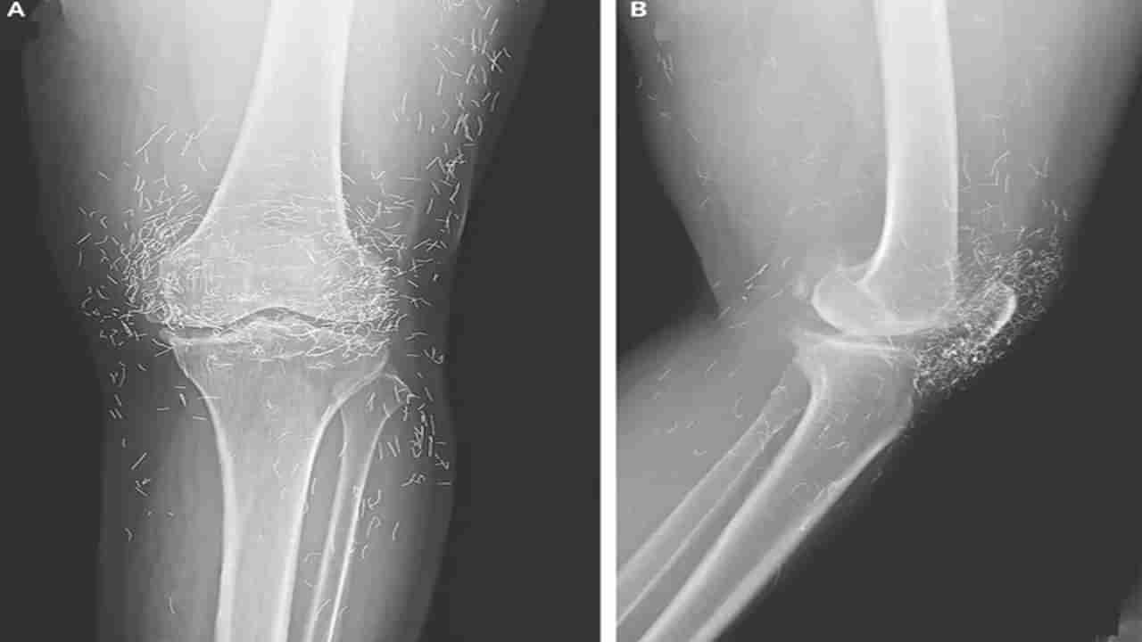 మోకాళ్ల నొప్పితో ఆస్పత్రికి వెళ్ళిన మహిళ.. ఎక్స్-రే చూసి డాక్టర్లు షాక్.. మోకాలిలో బంగారు తీగలు