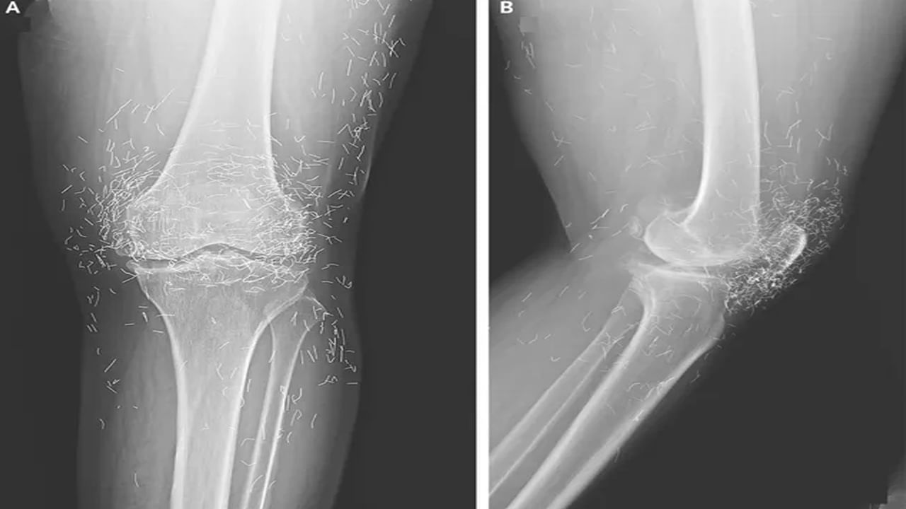 మోకాళ్ల నొప్పితో ఆస్పత్రికి వెళ్ళిన మహిళ.. ఎక్స్-రే చూసి డాక్టర్లు షాక్.. మోకాలిలో బంగారు తీగలు