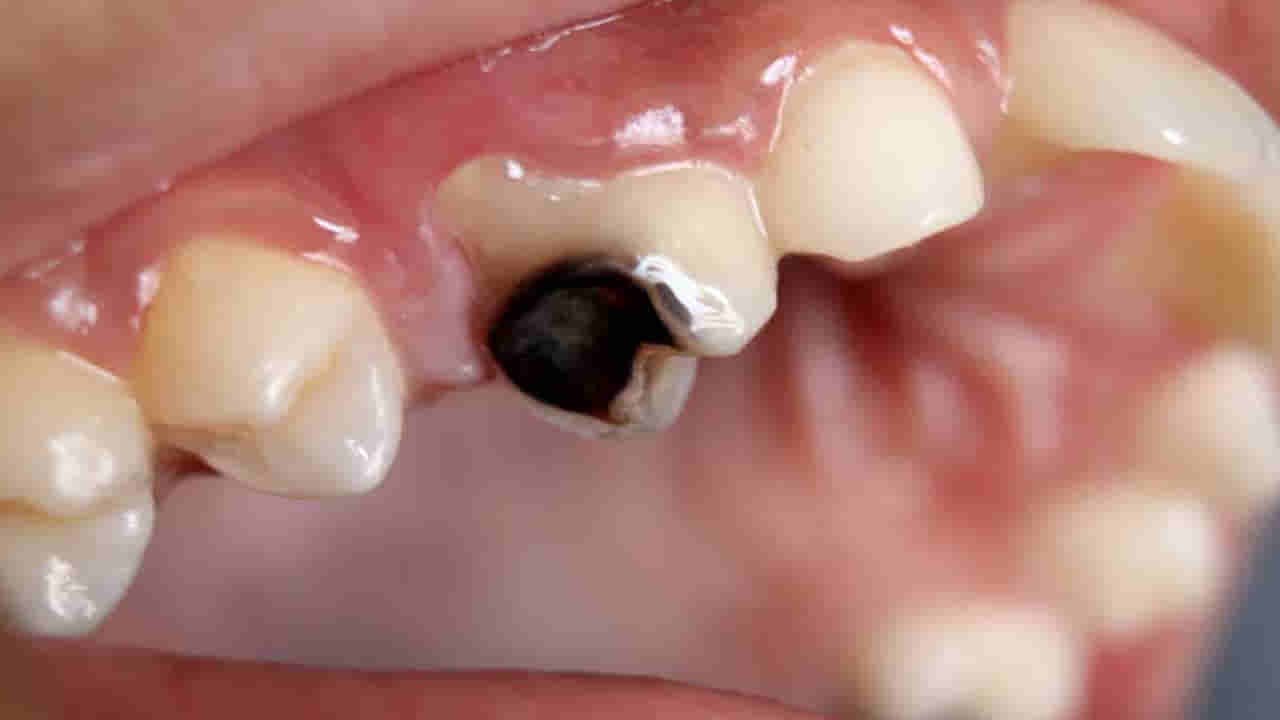 Andhra: క్లీనిక్కు వెళ్లి పిప్పి పళ్లు పీకించుకున్న మహిళ.. ఇంటికి వచ్చాక వాంతులు.. ఆపై