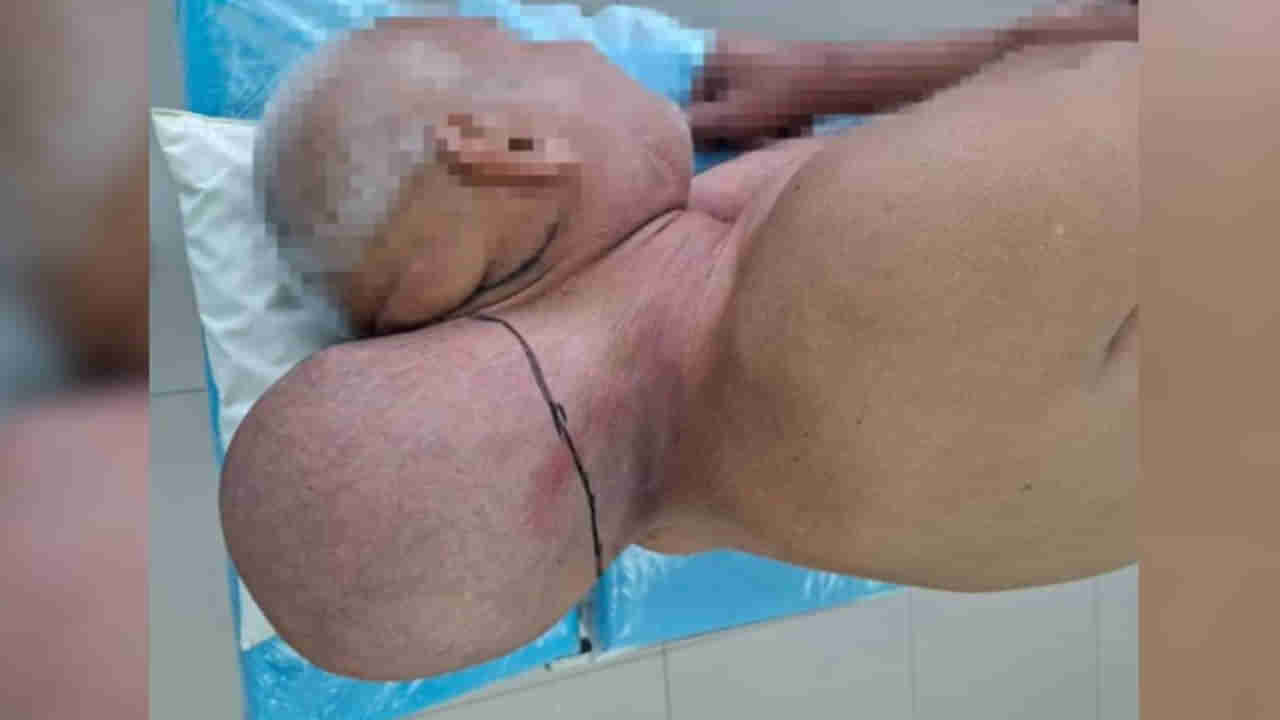 అయ్యబాబోయ్.. మెడమీద పుట్టుకొచ్చిన రెండో తల..! 16ఏళ్ల పాటు శరీరంలోనే దాక్కుంది.. చివరకు