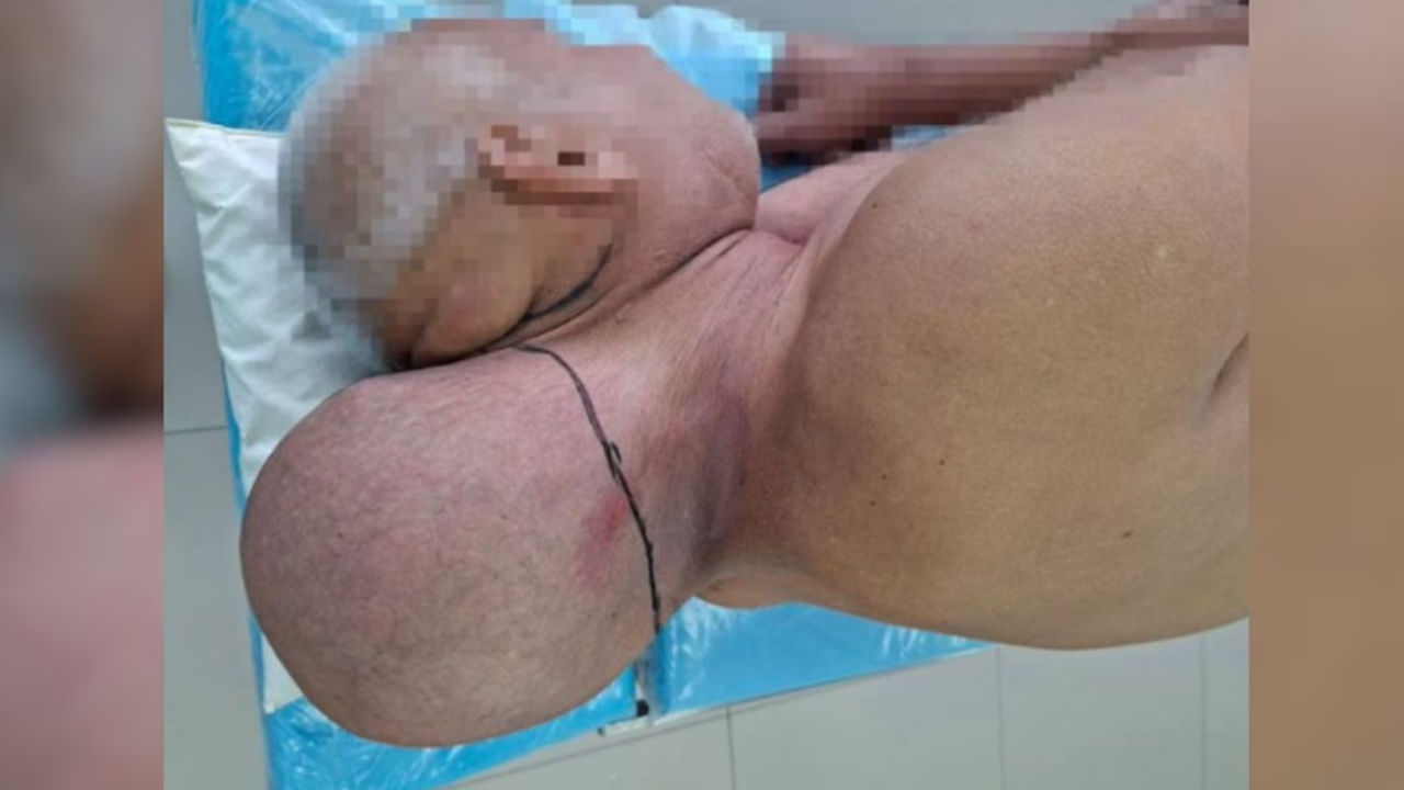 అయ్యబాబోయ్.. మెడమీద పుట్టుకొచ్చిన రెండో తల..! 16ఏళ్ల పాటు శరీరంలోనే దాక్కుంది.. చివరకు