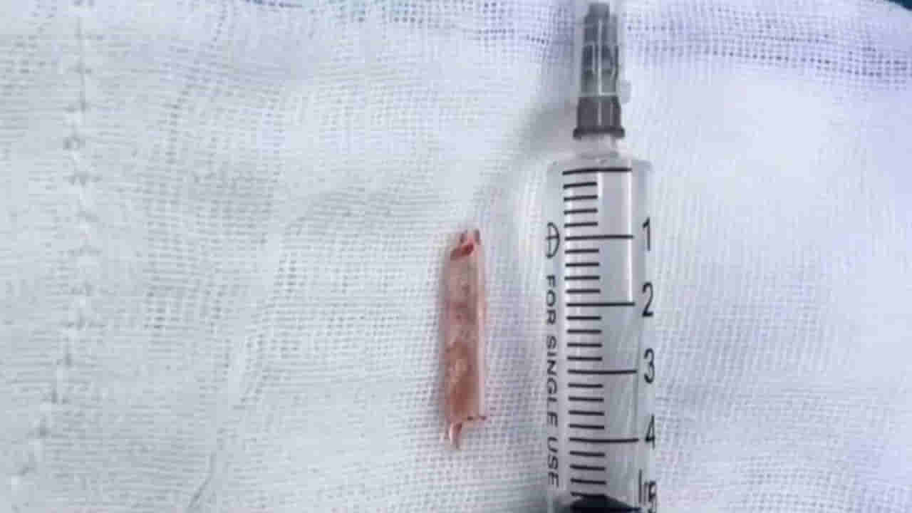 Viral: 22 ఏళ్లుగా మహిళకు కూర్చుంటే నొప్పి.. డాక్టర్లు CT స్కాన్‌ చేయగా.. అరడుగు పొడవైన