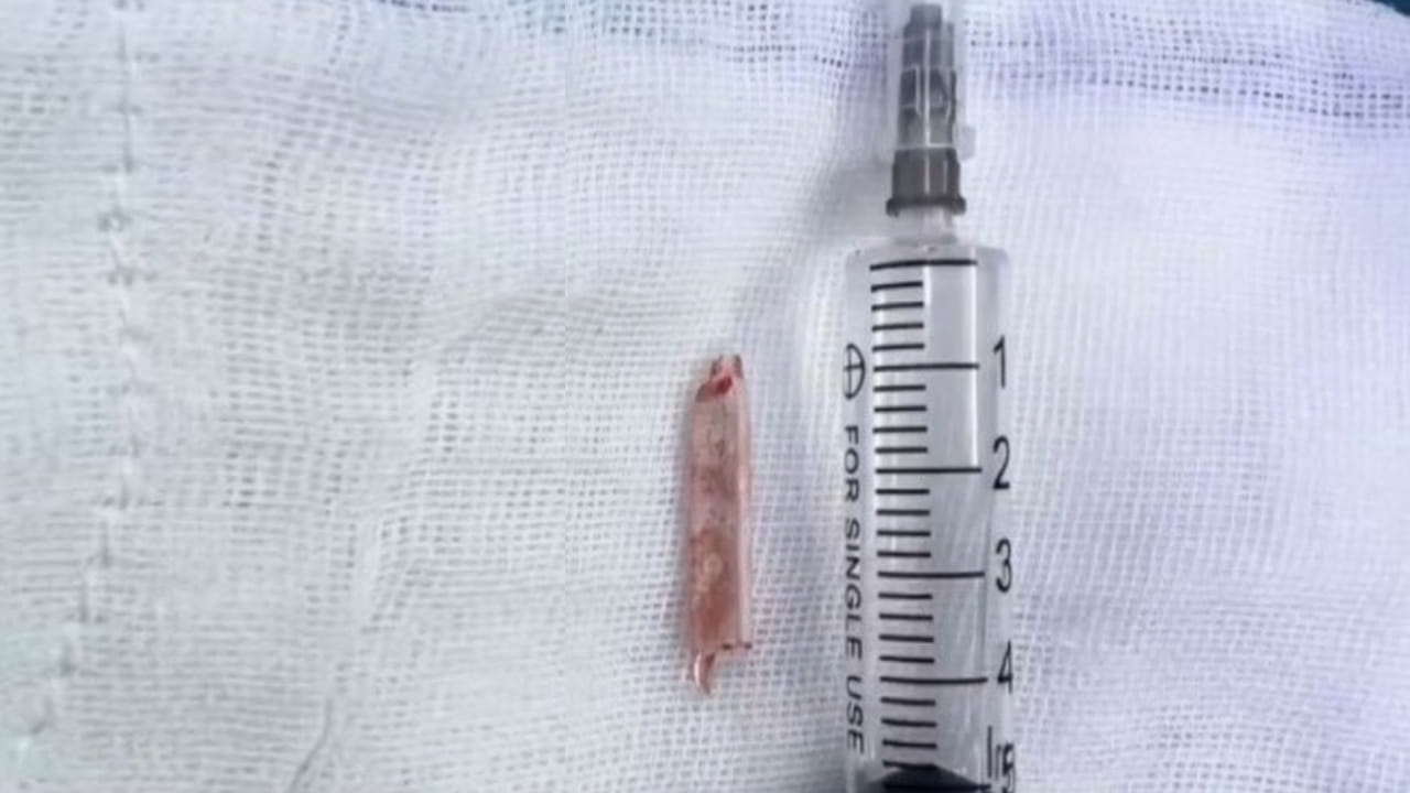 Viral: 22 ఏళ్లుగా మహిళకు కూర్చుంటే నొప్పి.. డాక్టర్లు CT స్కాన్‌ చేయగా.. అరడుగు పొడవైన