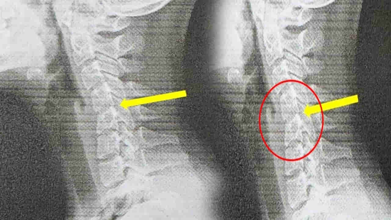 Viral: పదేపదే ఫోన్ చూసింది.. మెడ వాలిపోయి ఆస్పత్రిలో చేరింది.. టెస్టులు చేయగా