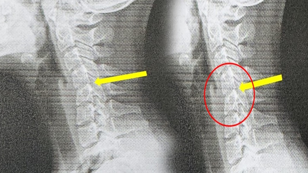 Viral: పదేపదే ఫోన్ చూసింది.. మెడ వాలిపోయి ఆస్పత్రిలో చేరింది.. టెస్టులు చేయగా