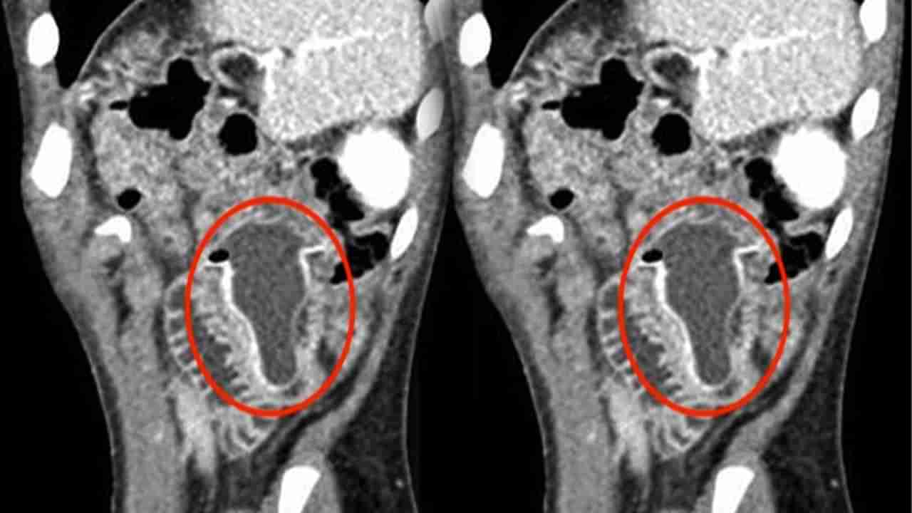 Viral: అక్కడెలా పెట్టుకున్నావురా.. 10 ఏళ్ల బాలుడికి ఎక్స్‌రే తీసి బిత్తరపోయిన డాక్టర్లు