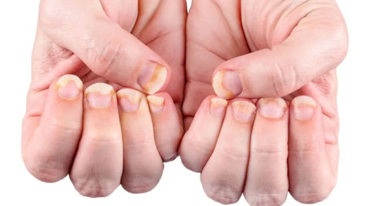 చాలా మందికి చేతి, కాళ్ల గోళ్లు విరిగిపోతుంటాయి. కొన్నిసార్లు అవి బలహీనంగా కూడా మారుతాయి. మీ గోళ్లు కూడా ఇలా తరచుగా విరిగిపోతుంటే లేదా బలహీనంగా మారితే ఇది దేనికి సంకేతమో ఇక్కడ తెలుసుకుందాం..