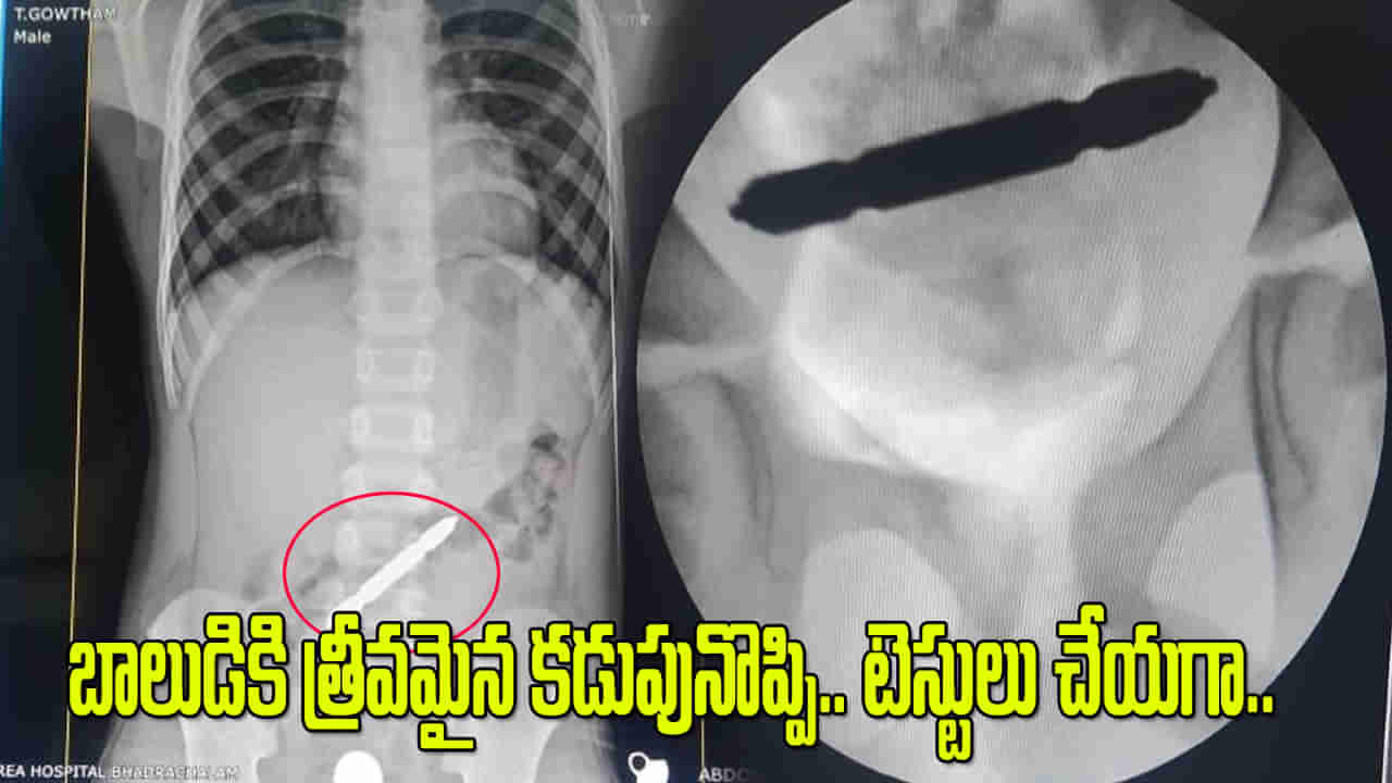 Andhra: బాలుడికి తీవ్రమైన కడుపునొప్పి.. ఆస్పత్రికి తీసుకెళ్లి టెస్టులు చేయగా.. ఎక్స్‌రేలో..