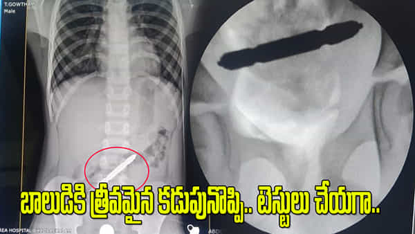 Andhra: బాలుడికి తీవ్రమైన కడుపునొప్పి.. ఆస్పత్రికి తీసుకెళ్లి టెస్టులు చేయగా.. ఎక్స్రేలో..