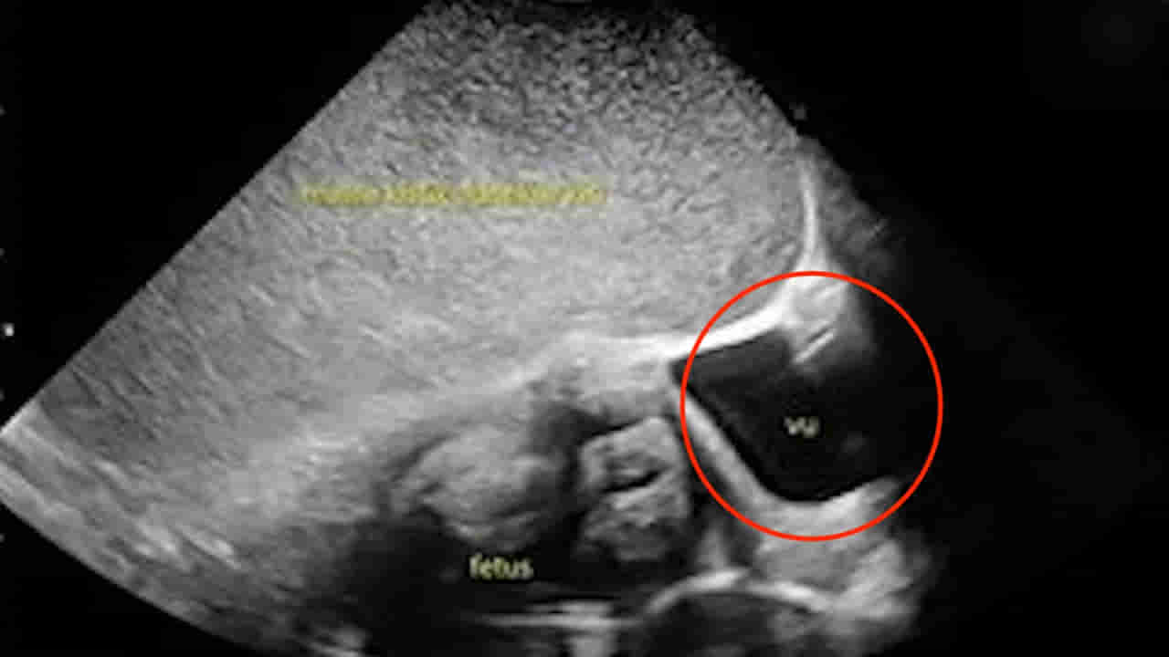 Viral: పురిటి నొప్పులతో అస్పత్రికొచ్చిన గర్భవతి.. కడుపులో ఉన్న పిండం ఎక్స్‌రే తీయగా