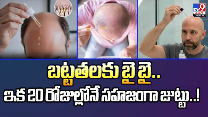 బట్టతలకు బై బై.. ఇక 20 రోజుల్లోనే సహజంగా జుట్టు..! బట్టతలకు బై బై.. ఇక 20 రోజుల్లోనే సహజంగా జుట్టు..!