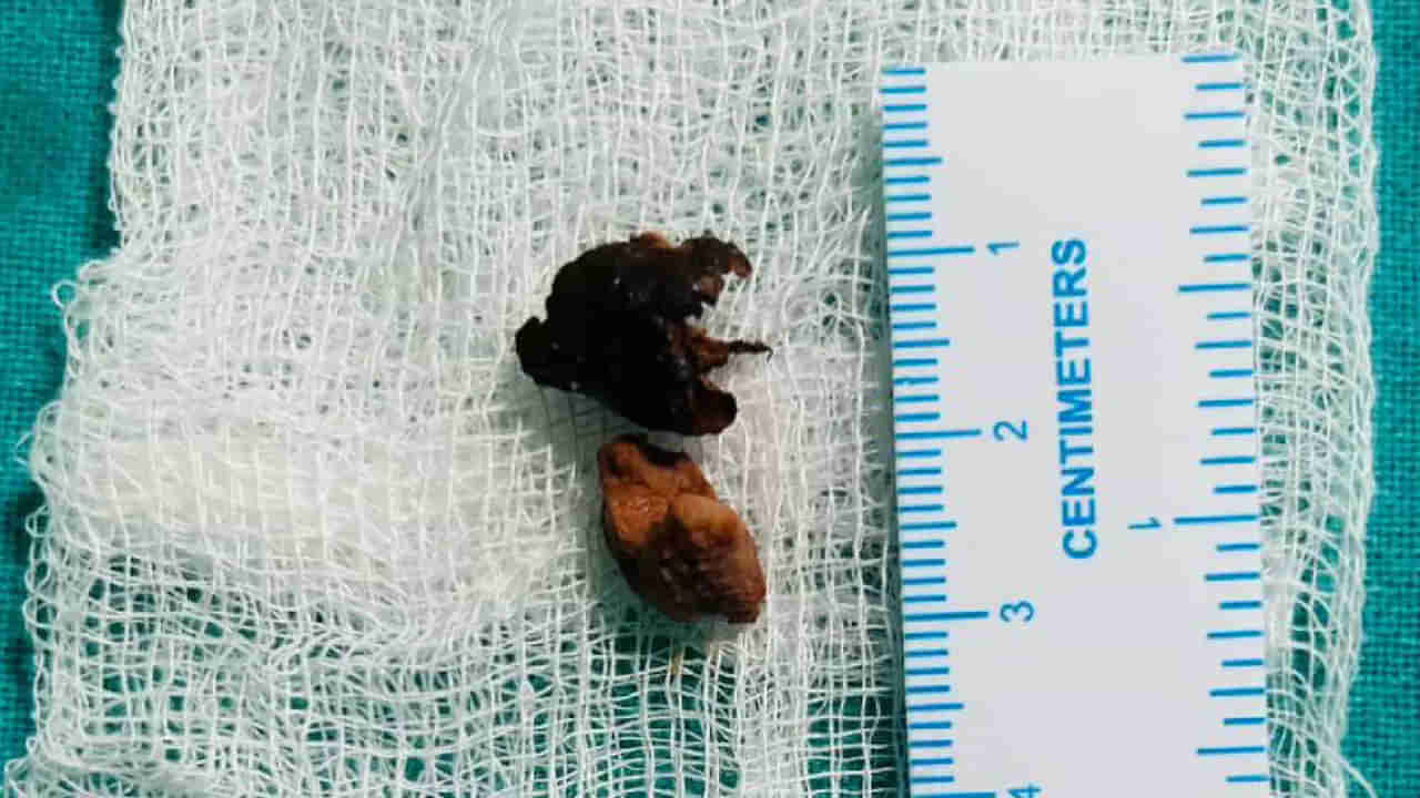 Andhra: ఆ మహిళకు 6 నెలలుగా తగ్గని జ్వరం, దగ్గు.. టెస్టులు చేయగా ఊపిరితిత్తుల్లో