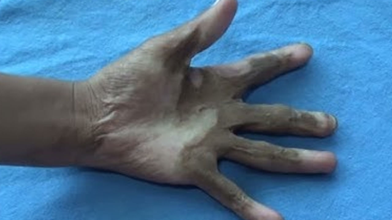 AP - Telangana: తెలుగు రాష్ట్రాల్లో కాలిన గాయాలు ఉన్నవారికి ఉచితంగా ప్లాస్టిక్ సర్జరీ.. వివరాలు ఇవిగో