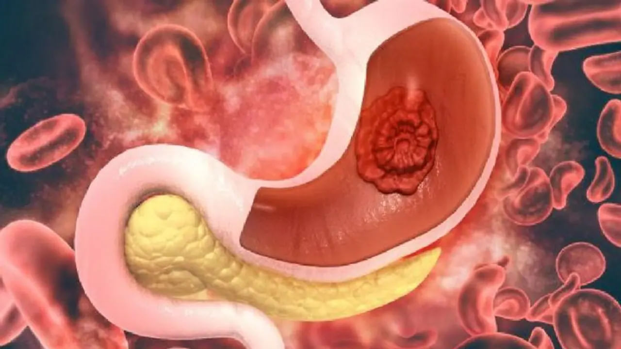 పొట్ట క్యాన్సర్ అనేది ఎక్కువగా ముదిరిపోయాక మాత్రమే బయటపడిపోతుంది.  అయితే ఎవరిలోనైతే ఎక్కువగా గ్యాస్ ఎసిడిడీ.  కడుపు ఉబ్బరం, ఎప్పుడూ కడుపు నొప్పి ఉంటే తప్పకుండా క్యాన్సర్ టెస్టులు చేయించుకోవాలంట. ముఖ్యంగా పొట్ట క్యాన్సర్ లక్షణాలు ఎక్కువగా కడుపు నొప్పి, గ్యాస్, మలబద్ధకం సమస్యలు నిరంతరం కనిపిస్తుంటాయి.