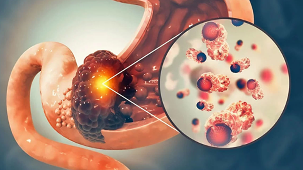 పొట్ట క్యాన్సర్ ఉన్నవారిలో ఉండే లక్షణాలు.. ఆకలి మందగించడం,  విపరీతంగా బరువు తగ్గడం, పొట్టలో ఏదో బరువుగా అనిపించడం జరుగుతుందంట. ఎప్పుడైనా సరే కడుపులో బరువుగా అనిపిస్తే, కడుపులో కణితి ఉన్నట్లేనంట. దీని వలన ఆకలి తగ్గిపోతూ ఉంటుందంట.