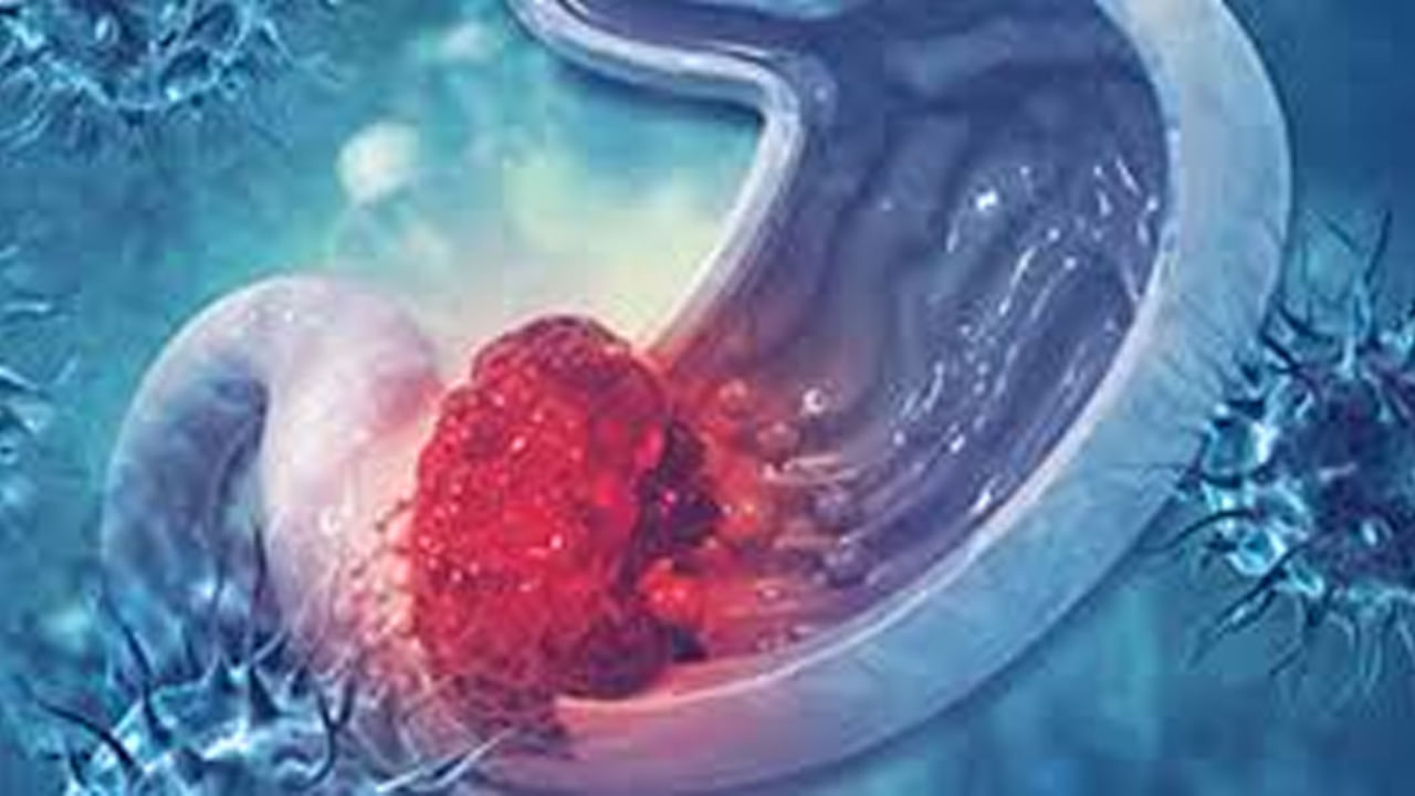 క్యాన్సర్ అనేది చాపకింద నీరులా వ్యాపిస్తుంది. ముఖ్యంగా చాలా మంది పొట్ట క్యాన్సర్ బారిన పడి ఇబ్బందులు ఎదుర్కొంటున్నారు. చాలా వరకు క్యాన్సర్ ప్రారంభంలో ఎలాంటి లక్షణాలు అంతగా తెలియడం లేదు. కానీ అది చివరి స్టేజ్‌లో ఉన్నప్పుడు మాత్రమే, చాలా వరకు బయటపడిపోతుంది. కానీ ఆలోపు ప్రాణం మీదకే ముప్పు వస్తుంది. అందుకే క్యాన్సర్ ప్రారంభంలోనే దాని లక్షణాలు గుర్తించాలంట.