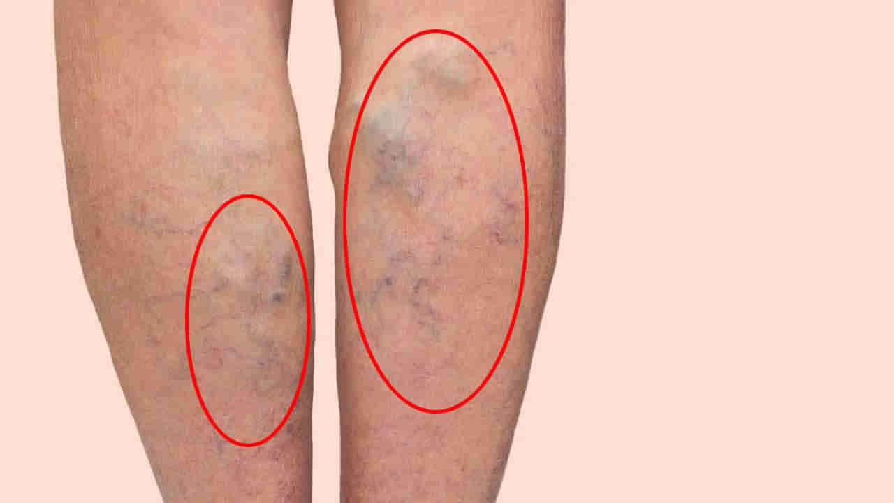 Varicose Veins in Women: ఆ సమయంలో మహిళల కాళ్లపై రక్తపు చారలు ఎందుకు? భయం వద్దు.. ఇలా చేయండి