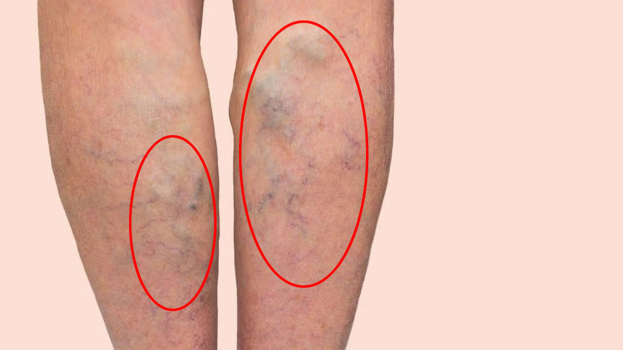 Varicose Veins in Women: ఆ సమయంలో మహిళల కాళ్లపై రక్తపు చారలు ఎందుకు? భయం వద్దు.. ఇలా చేయండి