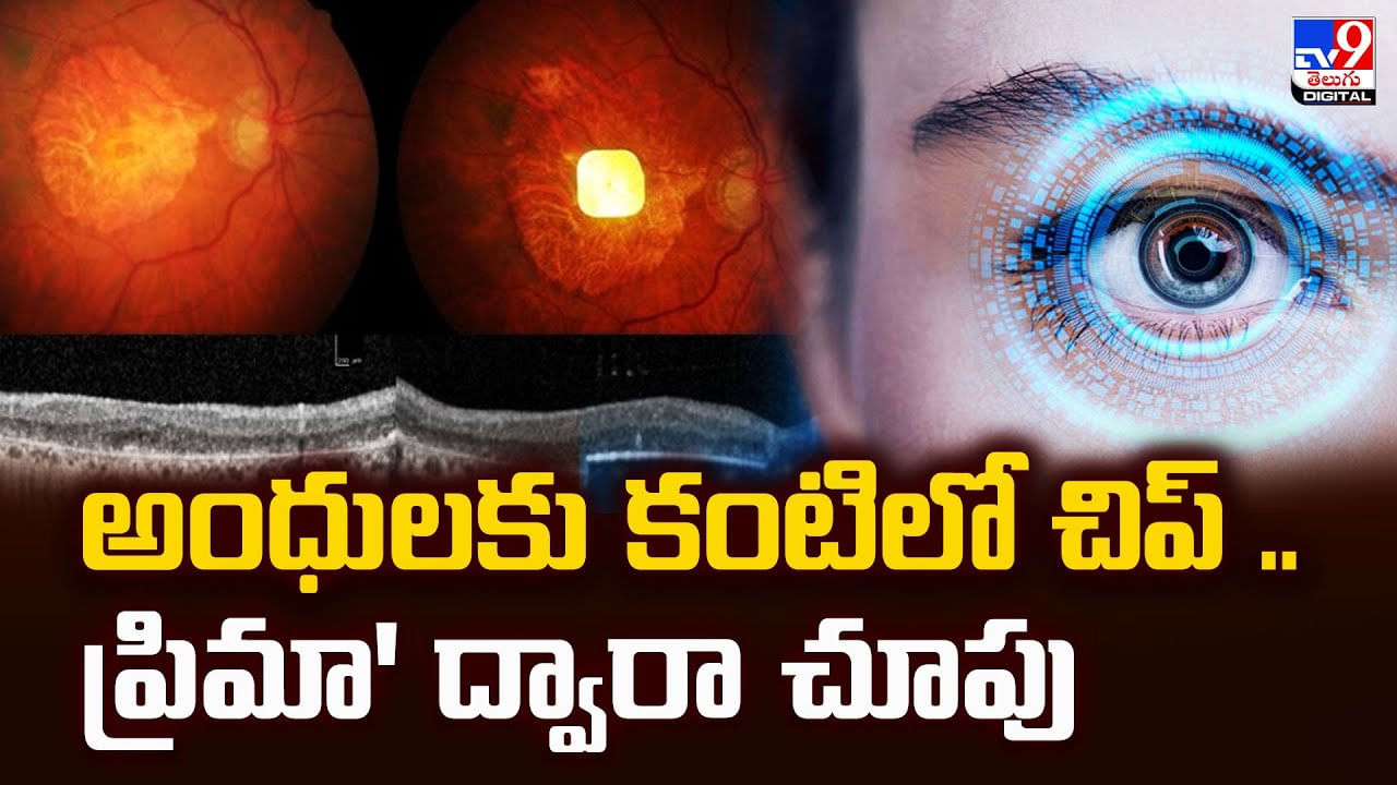 అంధులకు కంటిలో చిప్‌ .. టెక్నాలజీ ద్వారా చూపు