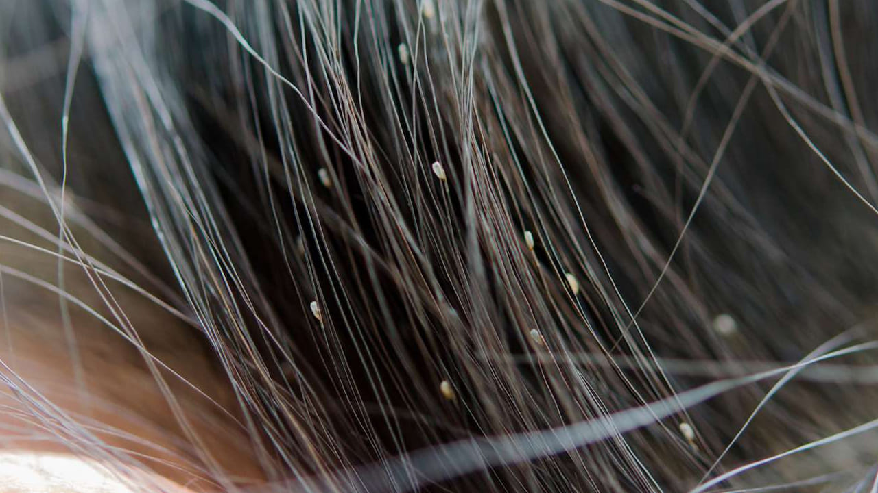 పేల సమస్య అనేది చాలా ఇబ్బందికరమైనదని చెప్పాలి. దీని వలన చాలా మంది సమస్యలు ఎదుర్కొంటారు. ముఖ్యంగా బహిరంగ ప్రదేశాల్లో ఇవి చాలా ఇబ్బందిని కలిగిస్తాయి. తలపై విపరీతమైన దురదతో బాధపడుతారు. అందుకే తలలో పేలు లేకుండా చూసుకోవాలంట. అయిత తలలో పేలు ఉండకూడదంటే కొన్ని చిట్కాలు పాటించాలి.