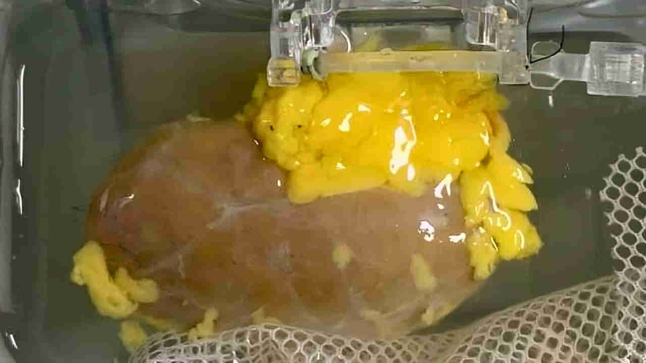 గుడ్న్యూస్.. బ్లడ్ గ్రూప్తో సంబంధం లేకుండా కిడ్నీ మార్పిడి? వైద్య రంగంలో కొత్త సంచలనం..