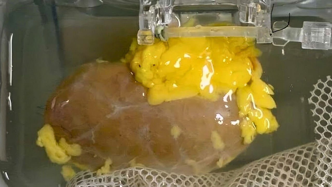 గుడ్న్యూస్.. బ్లడ్ గ్రూప్తో సంబంధం లేకుండా కిడ్నీ మార్పిడి? వైద్య రంగంలో కొత్త సంచలనం..