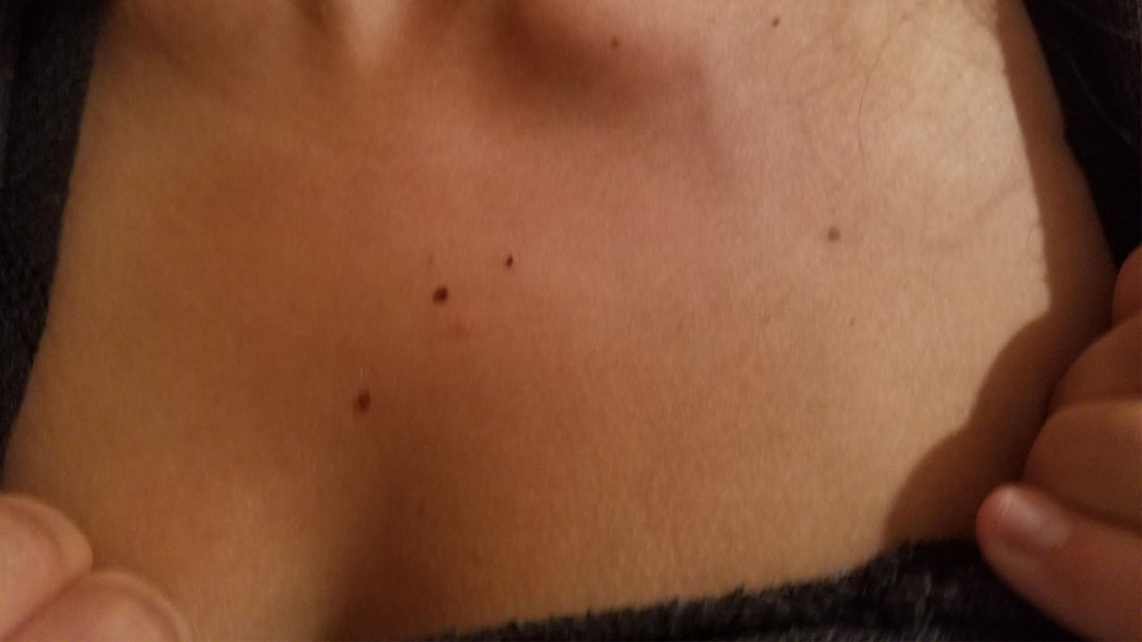 ఛాతీ మధ్యలో పుట్టు మచ్చ ఉన్న వ్యక్తులు కూడా చాలా అదృష్టవంతులుగా సముద్ర శాస్త్రం చెబుతుంది. ఈ వ్యక్తులకు జీవితంలో ఎంతో మంచి గౌరవం లభిస్తుంది. అలాగే నాభిపైన లేదా దాని చుట్టూ పుట్టుమచ్చు ఉంటే.. అది కూడా శుభ సంకేతంగా చెబుతారు.