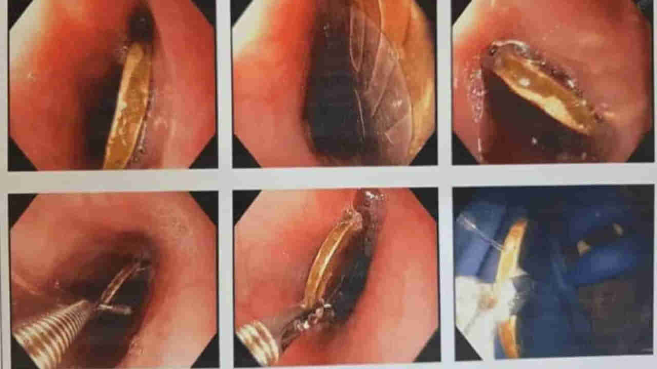 బాలుడి గొంతులో ఇరుక్కున్న రూ.10 నాణెం..! ఆ తర్వాత ఏం జరిగిందంటే?