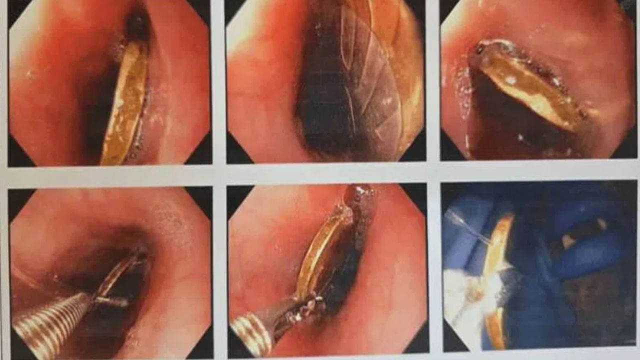 బాలుడి గొంతులో ఇరుక్కున్న రూ.10 నాణెం..! ఆ తర్వాత ఏం జరిగిందంటే?