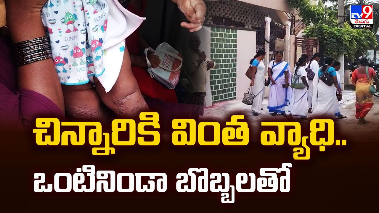 చిన్నారికి వింత వ్యాధి.. ఒంటినిండా బొబ్బలతో వీడియో