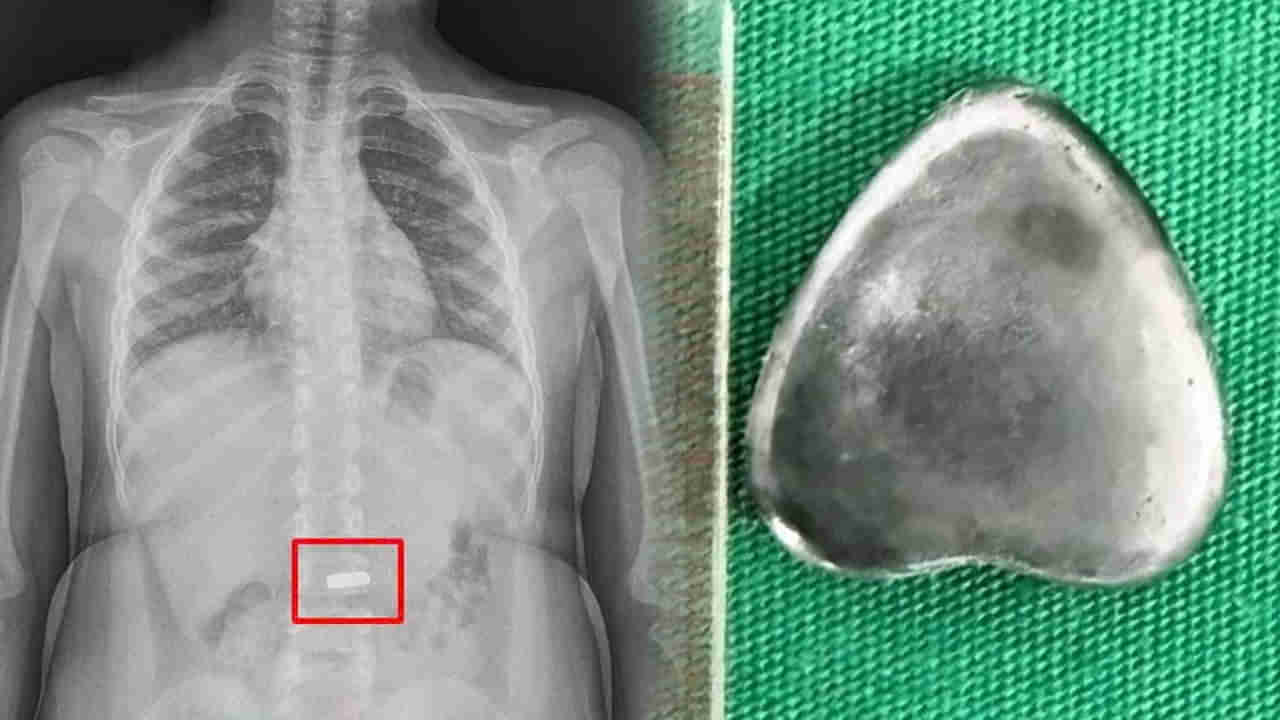 Viral: బుడ్డోడా అలా.. ఎలా మింగేశావ్రా.! ఎక్స్రే తీయగా కళ్లు తేలేసిన డాక్టర్లు