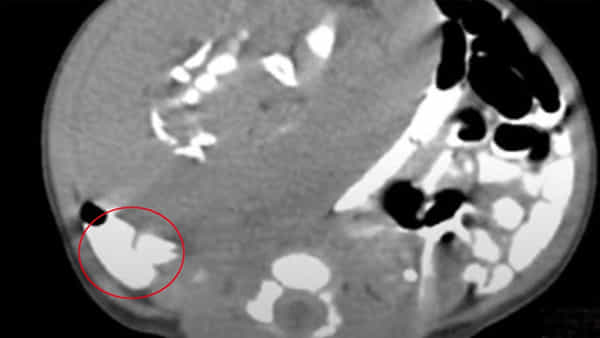 Viral: అప్పుడే పుట్టిన బిడ్డ కడుపులో వింత ఆకారం.. స్కాన్ చేసి కళ్లు తేలేసిన డాక్టర్లు