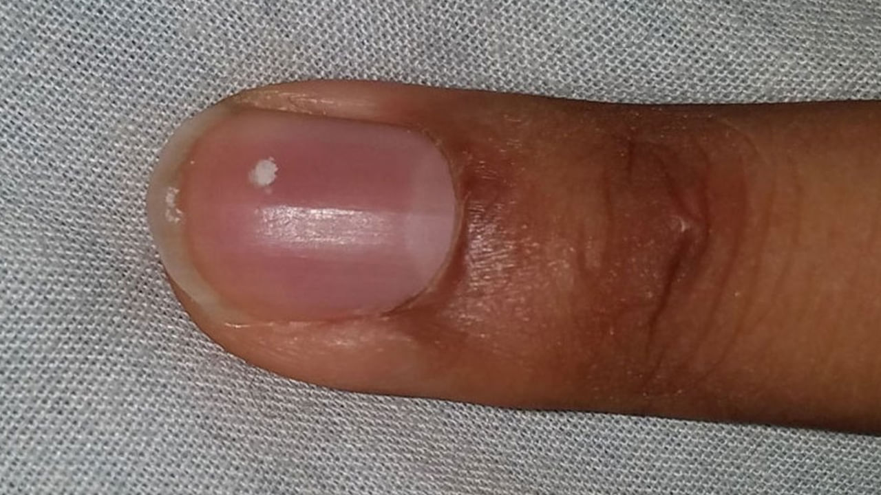 మీ కుడి చూపుడు వేలుగోలుపై ఈ తెల్లని మచ్చలు ఉండటం వల్ల మీరు మీ కెరీర్‌లో విజయం సాధిస్తారు. చూపుడు వేలుపై తెల్లని చుక్కలు ఉండటం వల్ల మాట్లాడే నైపుణ్యాలు మెరుగుపడతాయని నమ్ముతారు. అయితే ఈ చుక్కలు పదాలను తమ బలంగా భావించి పనిచేసే న్యాయవాదులు, జర్నలిస్టులు, మార్కెటింగ్ నిపుణులు, అనేక మంది ఇతరుల జీవితాల్లో గొప్ప మార్పులను తీసుకురాగలవు. అదే సమయంలో, మీ ఎడమ చేతి చూపుడు వేలుగోలుపై తెల్లటి మచ్చలు ఉంటే, అది కొత్త ప్రారంభానికి సంకేతంగా పరిగణించబడుతుంది. అంటే, మీరు కొత్త కెరీర్‌ను ప్రారంభించే అవకాశం ఉంటుంది. త్వరలో వివాహం చేసుకునే అవకాశం కూడా ఉంటుంది .