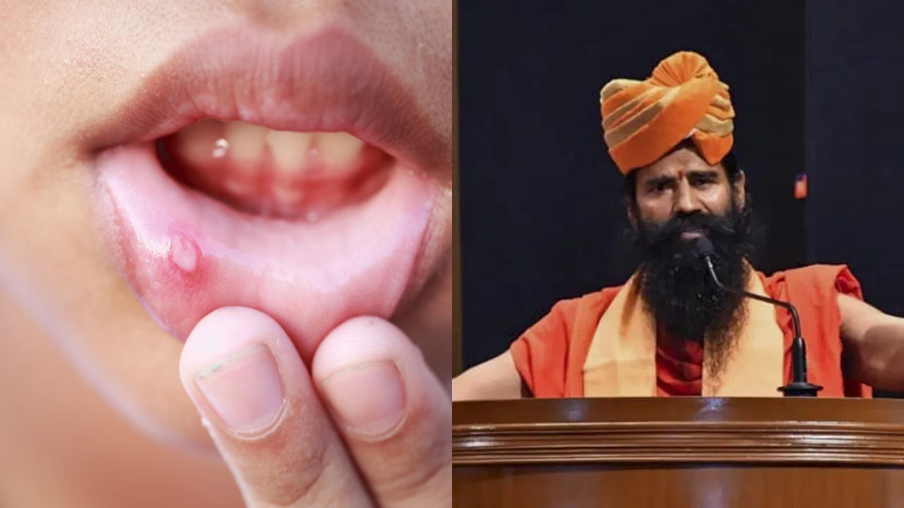 తరచూ నోటి పూతలతో బాధపడుతున్నారా?.. బాబా రామ్దేవ్ చెప్పిన ఈ సింపుల్ టిప్స్తో ఈజీగా చెక్పెట్టండి!