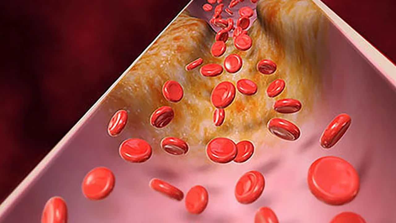 కొలెస్ట్రాల్.. పెను ప్రమాదకరంగా మారుతోంది.. ఇది ప్రమాదకర జబ్బుల బారిన పడేలా చేస్తోంది.. అధిక కొలెస్ట్రాల్ ప్రాణాంతక గుండె జబ్బులు, స్ట్రోక్ ప్రమాదానికి దారి తీస్తుందని వైద్య నిపుణులు హెచ్చరిస్తున్నారు. అటువంటి పరిస్థితిలో చెడు కొలెస్ట్రాల్ పెరగకుండా.. అదుపులో ఉంచుకోవడం చాలా ముఖ్యం.. ముఖ్యంగా శరీరంలో కొవ్వును నియంత్రించేందుకు మంచి జీవనశైలిని.. ఆరోగ్యకరమైన ఆహారాన్ని తీసుకోవడం చాలా మంచిది.