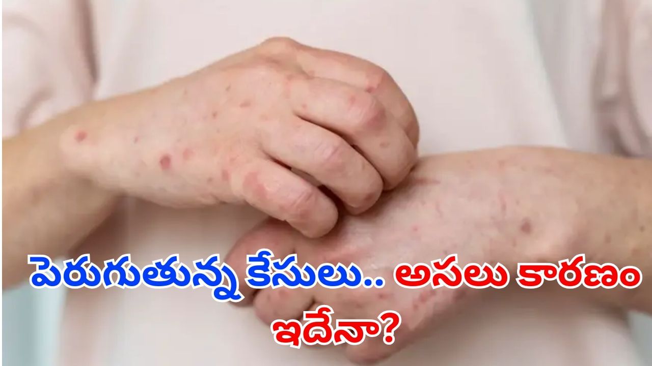 Blood infection: వామ్మో.. పెరుగుతున్న బ్లడ్ ఇన్ఫెక్షన్ కేసులు.. అసలు కారణాలు ఇవేనట
