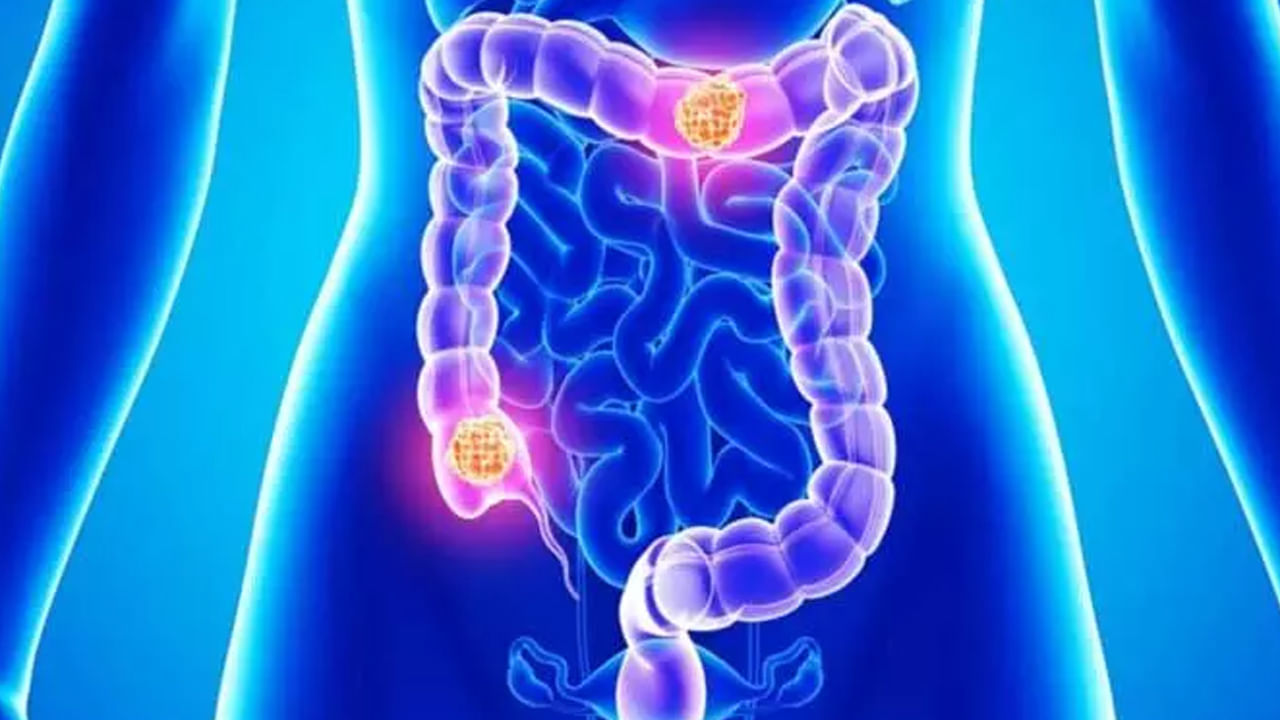 ఇవే కాకుండా కొంత మంది ఉన్నట్లుండి ఒక్కసారిగా విపరీతంగా బరువు తగ్గిపోతారు. అలాగే, మలవిసర్జన చేసినా, కడుపు ఖాళీ అయినట్లు అనిపించకపోవడం, తీవ్రంగ, అలసట, నీరసం, ఆకలి తగ్గిపోవడం, ఎంత తిన్నా బక్కగా కనిపించడం, ఇవన్నీ కూడా పెద్ద పేగు క్యాన్సర్ లక్షణాలే, అంటున్నారు ఆరోగ్య నిపుణులు.