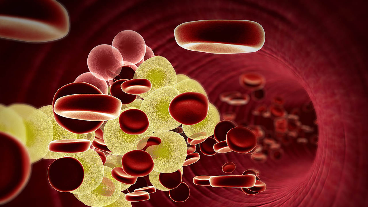 మూత్రంలో స్ఫటికాలు: శరీరంలో చెడు కొలెస్ట్రాల్ పెరిగినప్పుడు, అది స్ఫటికాల ద్వారా మూత్రంలో రావడం ప్రారంభమవుతుంది. కొలెస్ట్రాల్ స్ఫటికాలు చిన్న పరిమాణంలో ఉంటే మూత్రం ద్వారా వెళ్లడం సాధారణం. కానీ దాని పరిమాణం పెరిగేకొద్దీ కిడ్నీ దెబ్బతినే ప్రమాదం ఉంది. దీనిని నెఫ్రోటిక్ సిండ్రోమ్ యొక్క లక్షణం అని కూడా పిలుస్తారు. మీకు ఇలాంటి అనుభవం ఉంటే, వెంటనే వైద్యుడిని సంప్రదించండి.