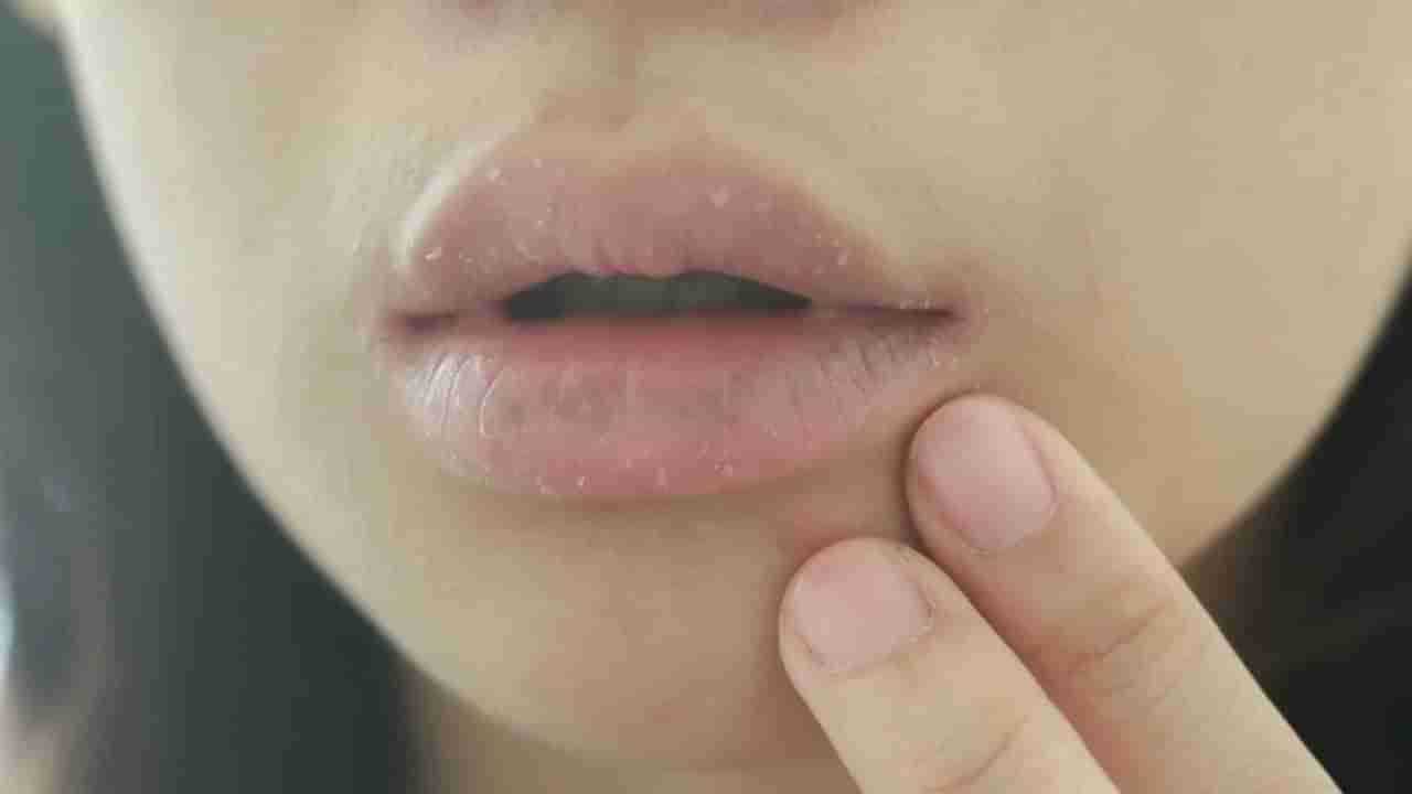 Winter 2025: చలికాలంలో పెదవులు పగలడానికి కారణం ఏంటో తెలుసా?.. ఆ సమస్యకు ఎలా చెక్ పెట్టాలి!